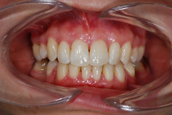 Adultes - Parmelan Orthodontie